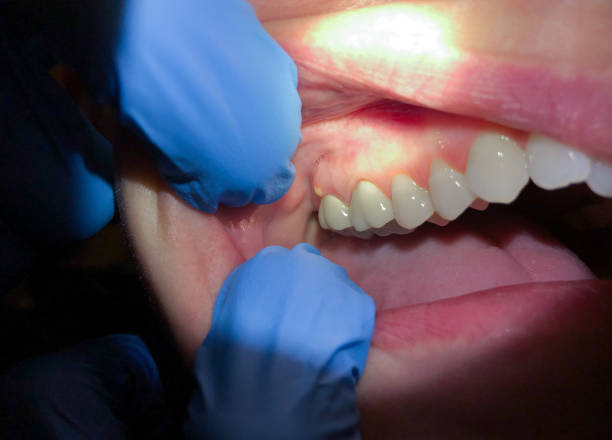 Best Emergency Treatment for Dental Infections or Abscesses in Falfurrias, TX