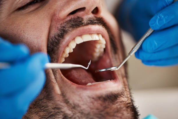 Best Emergency Wisdom Teeth Removal in Falfurrias, TX